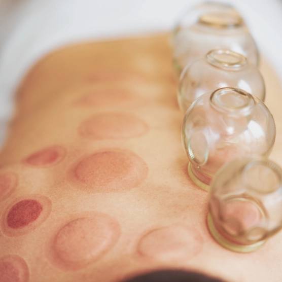 home-cupping-therapy-img