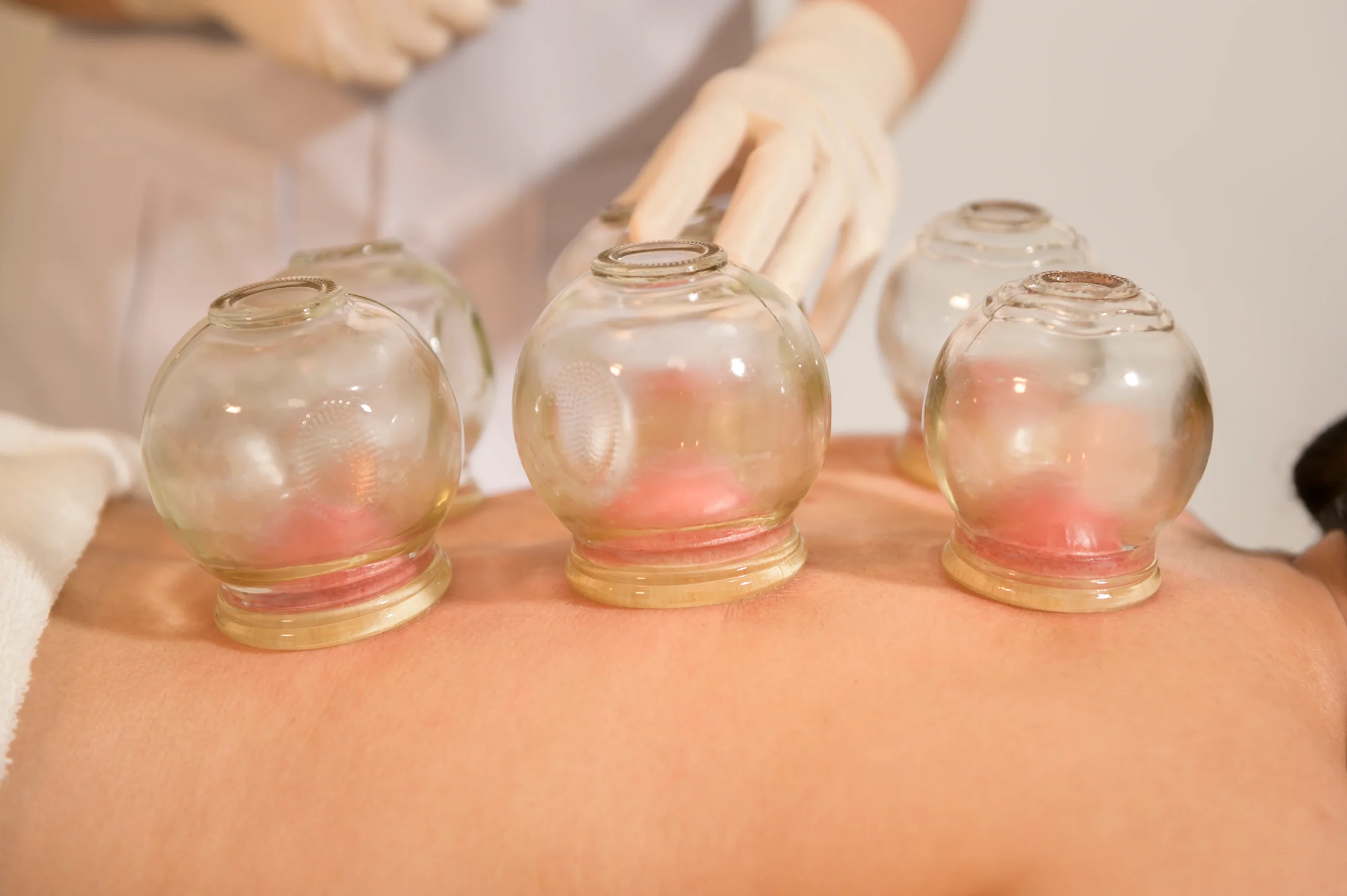 xabeautiful woman received cupping treatment back by therapist chinese scaled